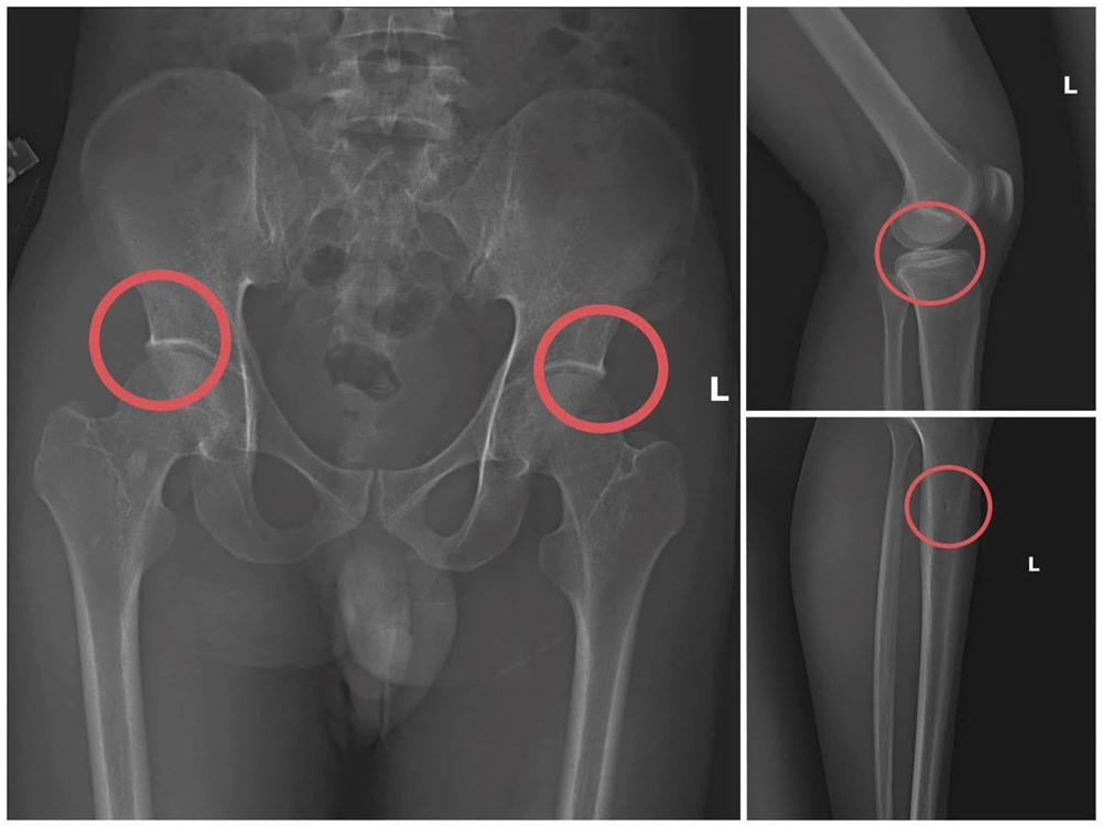 Vạch trần đường dây trục lợi bảo hiểm: Tiêm thuốc mê, dùng búa đập xương để lấy tiền bồi thường - ảnh 2